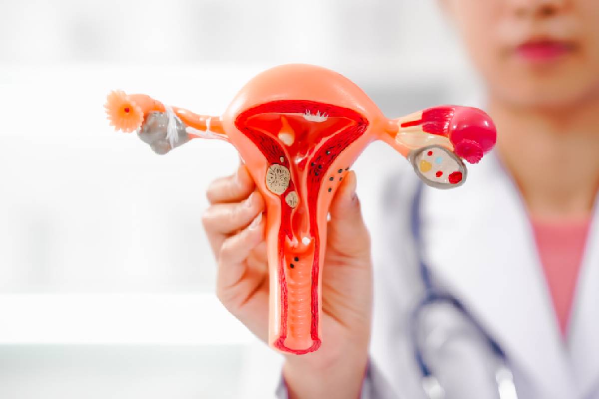 What Is the Acessa Procedure for Fibroids?